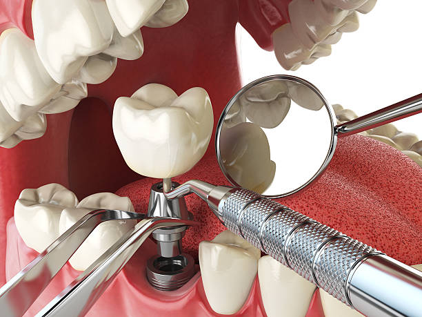 Best Emergency Dentist for Knocked-Out Tooth in Warson Woods, MO